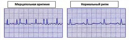 aritmii cardiace în ECG