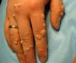 Verruca вулгарис - причини, симптоми, диагностика и лечение