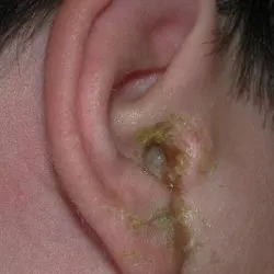 Betegség emberi fül