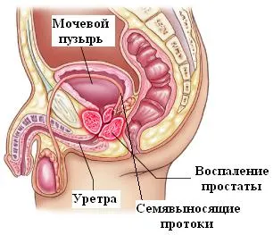 Durerea in timpul prostatei acolo unde doare adenomul de prostata (abdomen, spate, picioare)