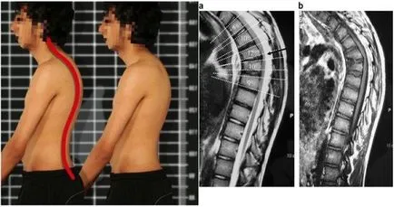 boala Mau simptome, diagnostic, tratament Scheuermann lui