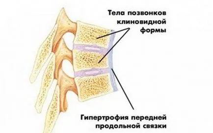 болест Мау симптоми, диагностика, лечение на Scheuermann