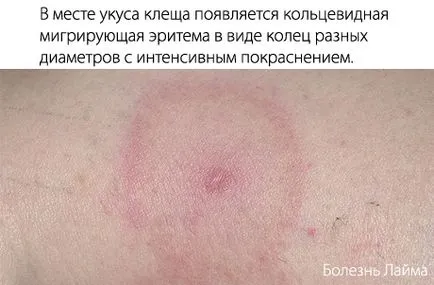 Lyme-kór (Lyme borreliosis) gyermekeknél - tünetek, megelőzésére és kezelésére, a Lyme-kór