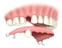 Clasp protezelor dentare „pro“ și „contra“
