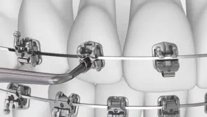 ortodonție americane între paranteze (American Ortodonție) opinii, opinii, preț
