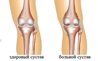 Ce se întâmplă dacă genunchi refrigerate și cum să-l trateze