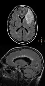 Mit jelent a MRI az agy stroke, egy második véleményt