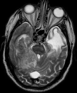 Mit jelent a MRI az agy stroke, egy második véleményt