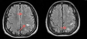 Mit jelent a MRI az agy stroke, egy második véleményt