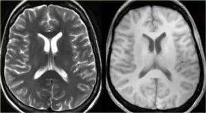 Mit jelent a MRI az agy stroke, egy második véleményt