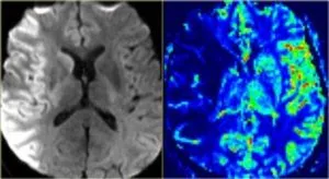 Mit jelent a MRI az agy stroke, egy második véleményt