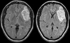 Mit jelent a MRI az agy stroke, egy második véleményt