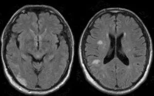 Mit jelent a MRI az agy stroke, egy második véleményt