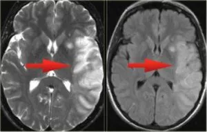 Mit jelent a MRI az agy stroke, egy második véleményt