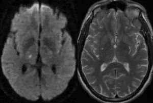 Mit jelent a MRI az agy stroke, egy második véleményt