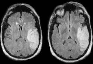 Mit jelent a MRI az agy stroke, egy második véleményt