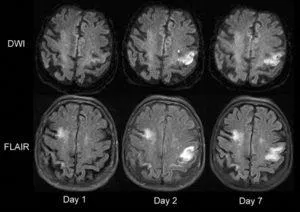 Mit jelent a MRI az agy stroke, egy második véleményt