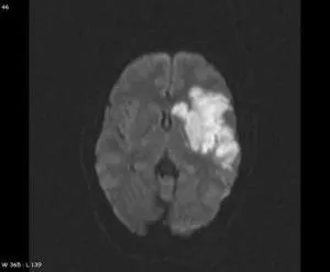 Mit jelent a MRI az agy stroke, egy második véleményt