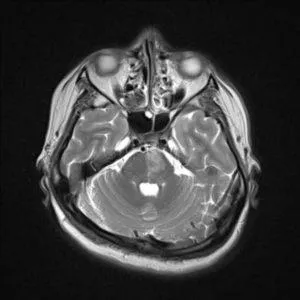 Mit jelent a MRI az agy stroke, egy második véleményt