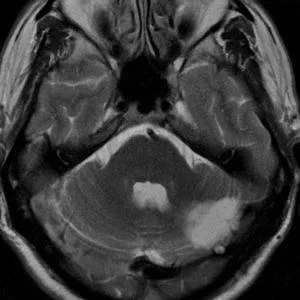 Mit jelent a MRI az agy stroke, egy második véleményt