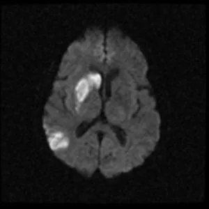 Mit jelent a MRI az agy stroke, egy második véleményt