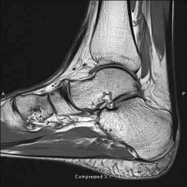 MRI mutatja, hogy a kar vagy láb