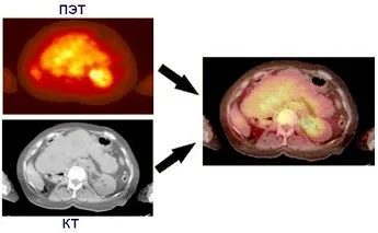 Какво е PET CT изследване