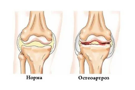 Дегенерация, дегенеративни промени менискусен коленните