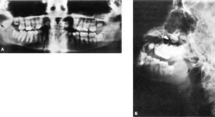 Diagnosticul de fracturi mandibulare