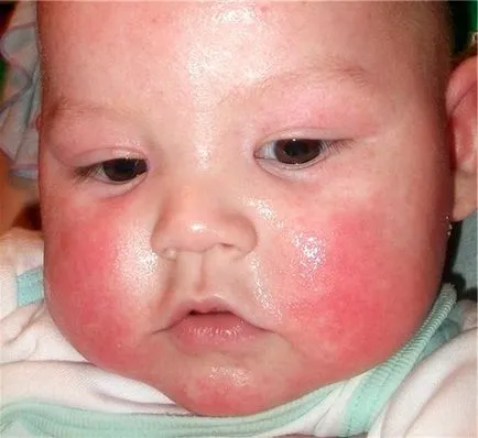 Диатеза в лечение на новородено лицето