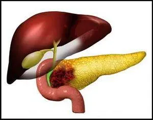 retete eficiente pentru tratarea pietrelor in pancreas