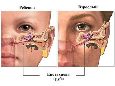 Cauzele bilaterale tubo otită și simptome, diagnostic si tratament