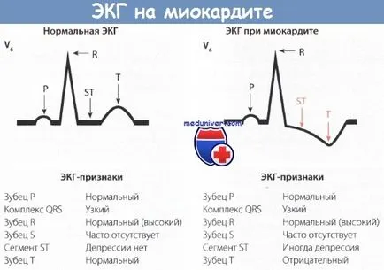 ECG în miocardita