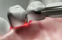 Erbium лазер в стоматологията