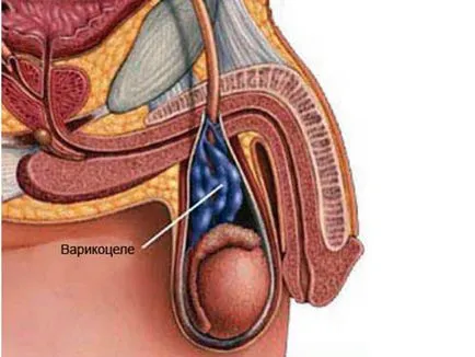 Embolizarea varicocel unei metode noi și eficiente de chirurgie