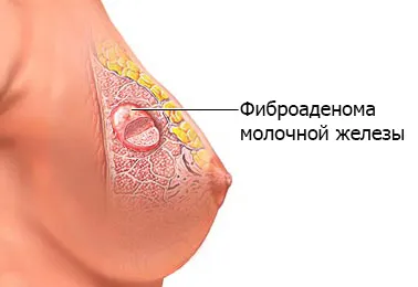 Фиброаденома на симптомите на гърдата, отстраняване, прогноза