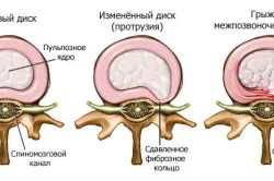 Foraminal класификация херния на болести, причини, лечение (видео)