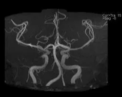 Хипоплазия на гръбначния артерия (вдясно, вляво), че това лечение, последствията - Здравна информация