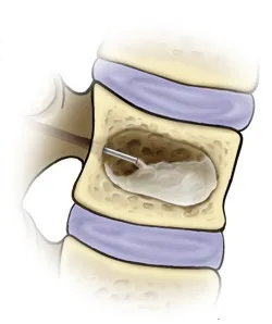 spinális hemangioma tumor kezelésére különböző módszerek