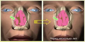 Хиперплазиралите ринит характеристика на заболяването, причините и лечението на това заболяване