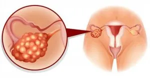Hiperandrogenism de origine ovariana, în special de tip ușoară de patologie