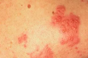 Herpes pe papa, coccisul sau fese cauze si tratament