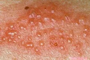 Herpes pe papa, coccisul sau fese cauze si tratament