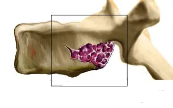 spinális hemangioma tumor kezelésére különböző módszerek