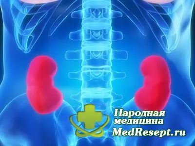 hidronefroza rinichi cauze, simptome si tratament - sfaturi medicale