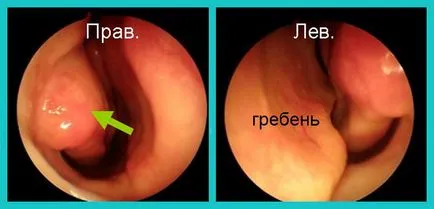 Хипертрофичната лечение ринит и диагностика на носа