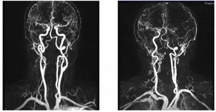 Хипоплазия на гръбначния артерия (вдясно, вляво), че това лечение, последствията - Здравна информация