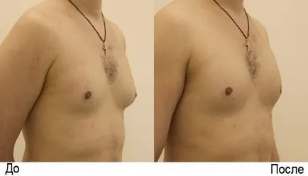 Gynecomastia műtét eltávolítani a férfiak