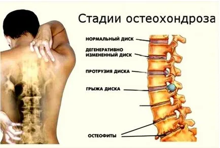 Гимнастика в остеохондроза на гръдна физиотерапия като лечение