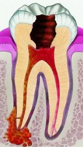 Гранулом на зъб корен